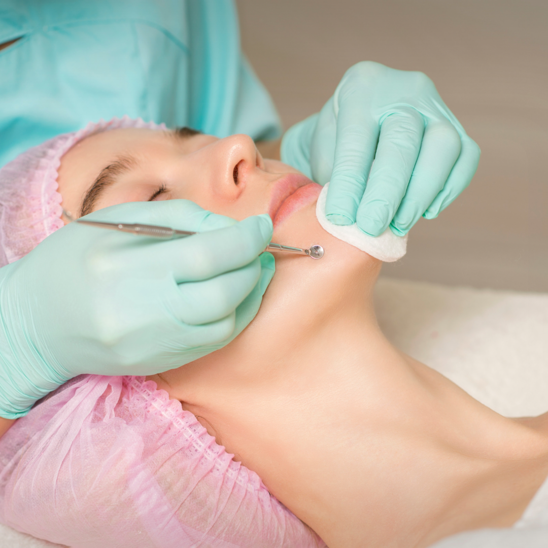 Blackhead Extractions